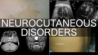 Neurocutaneous Disorders [upl. by Triplett451]