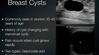 Breast Ultrasound [upl. by Cy]