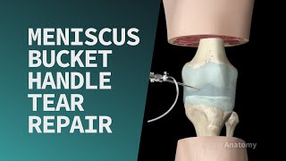 Meniscus Bucket Handle Tear Repair [upl. by Nordin]