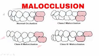 Malocclusion  Part I [upl. by Anavoig]