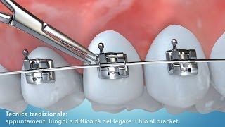 Video Animazione 3D tecnica di allineamento dentale con bracket [upl. by Cardwell578]