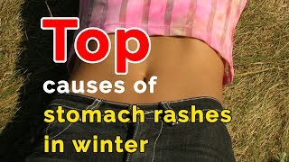 What causes rashes on the abdomen during winter  Dr Rajdeep Mysore [upl. by Eisej565]