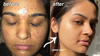 how i cleared my acne FOR GOOD something finally worked [upl. by Katleen79]