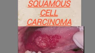 Squamous cell carcinoma Oral Cancer [upl. by Bringhurst143]