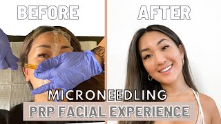 Full PRP Facial  Microneedling Experience  BeforeAfter Recovery [upl. by Noxaj]