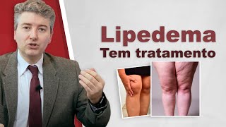 Tratamento de Lipedema Tem tratamento [upl. by Tollmann]