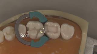 Class II Composite Restoration  Stevenson Dental Solutions [upl. by Denae376]