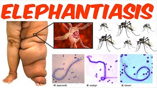 Lymphatic Filariasis  Elephantiasis [upl. by Godwin]