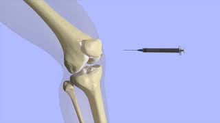 Knee Joint Injection [upl. by Tammany]