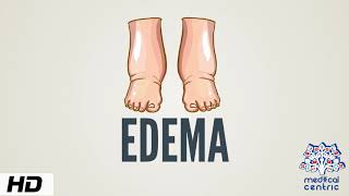 Edema Causes Signs and Symptoms Diagnosis and Treatment [upl. by Carew]