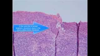 Squamous Cell Carcinoma [upl. by Inavoj]