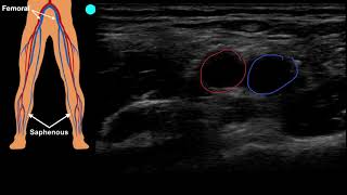 POCUS Venous Access  Part 1 [upl. by Hyrup]