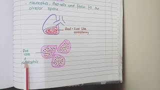 Lobar Pneumonia And Bronchopneumonia  Pathology [upl. by Thurstan]