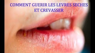 COMMENT SOIGNER LES LÈVRES SÈCHES ET CREVASSER [upl. by Ainsworth]