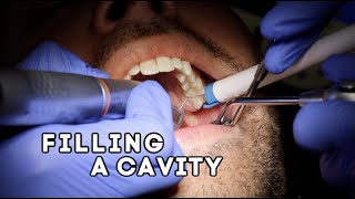 How Does A Dentist Fill A Cavity [upl. by Ibmat387]