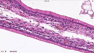 Ovary Mucinous cystadenocarcinoma [upl. by Nytram]