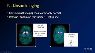 Neuroradiology board review lecture 1 neurodegenerative review [upl. by Farand914]