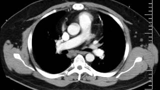 Mediastinal anatomy and nodal stations on CT [upl. by Jessamyn]