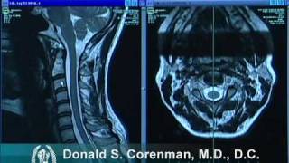 How to Read a MRI of the Normal Cervical Spine Neck  Colorado Spine Expert [upl. by Lennahs205]