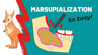 Marsupialization  WHEN WHY amp HOW [upl. by Illehs]