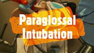 Vie Scope® Paraglossal Intubation OffMolar Intubation [upl. by Finegan721]