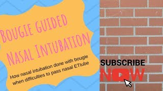 Bougie guided nasal intubation [upl. by Akiwak]