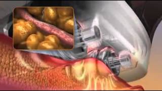 How VelaShape Works [upl. by Tudor]