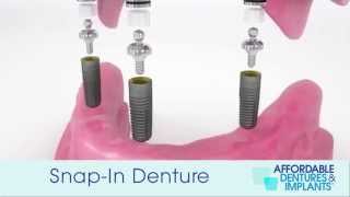 Demo How Do SnapIn Dentures With Implants Work [upl. by Anelagna]