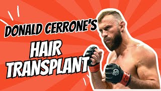 Donald Cerrones Hair Transplant A Deep Dive [upl. by Vizza]