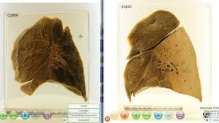 Lobar pneumonia vs Bronchopneumonia [upl. by Capps]