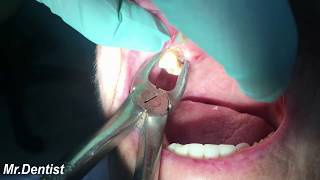 Extraction Of Molar Tooth [upl. by Ahsiened]