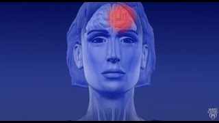 Learn About Migraine Aura [upl. by Haniraz]