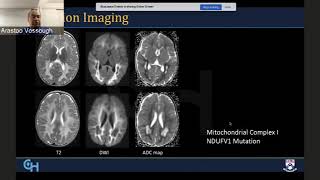 TMT NeuroRadiology by Dr Deepak Patkar Pediatric White Matter disease Part I [upl. by Ofelia]