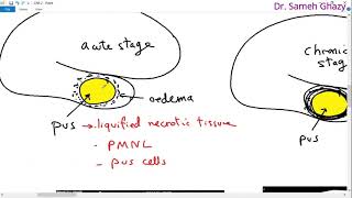 Systemic pathology 18  CNS 2 brain abscess and degenerations  DRSAMEH GHAZY [upl. by Cleon]