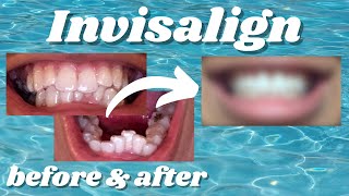 My Incredible Invisalign Transformation [upl. by Nevur539]